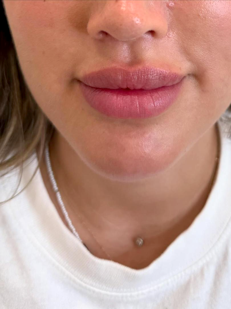 Lips Filler Before