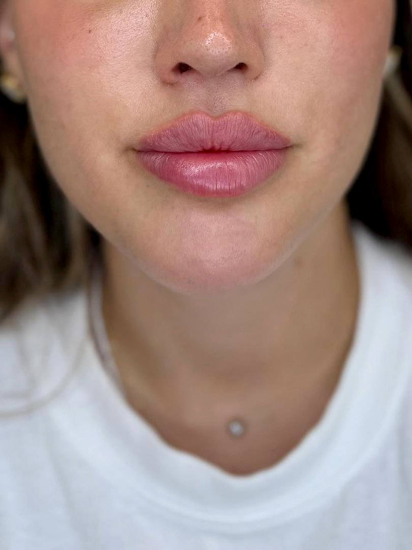 Lips Filler After