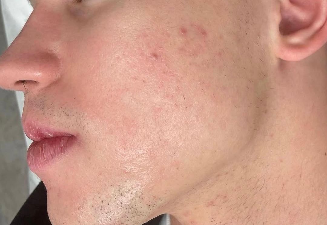 Skin Treatment Before